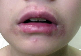 口唇ヘルペスの症状